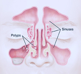 Treatment for Nasal Polyps | Saint Luke's Health System